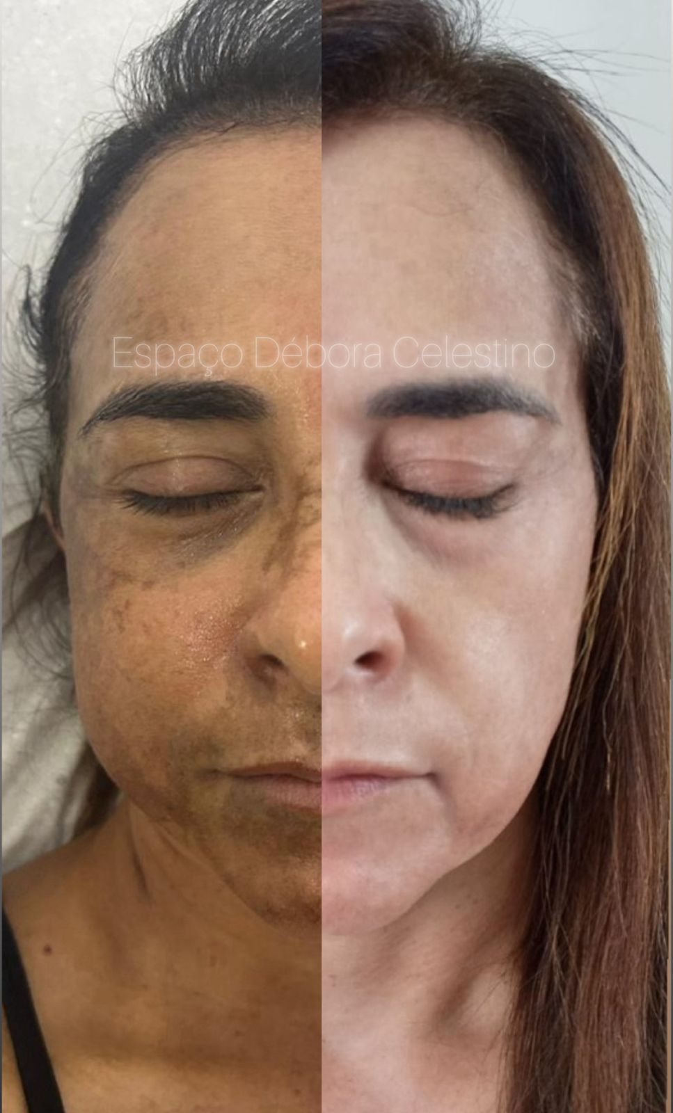 Resultado real 5 — Protocolo Renewal Clareamento Inteligente