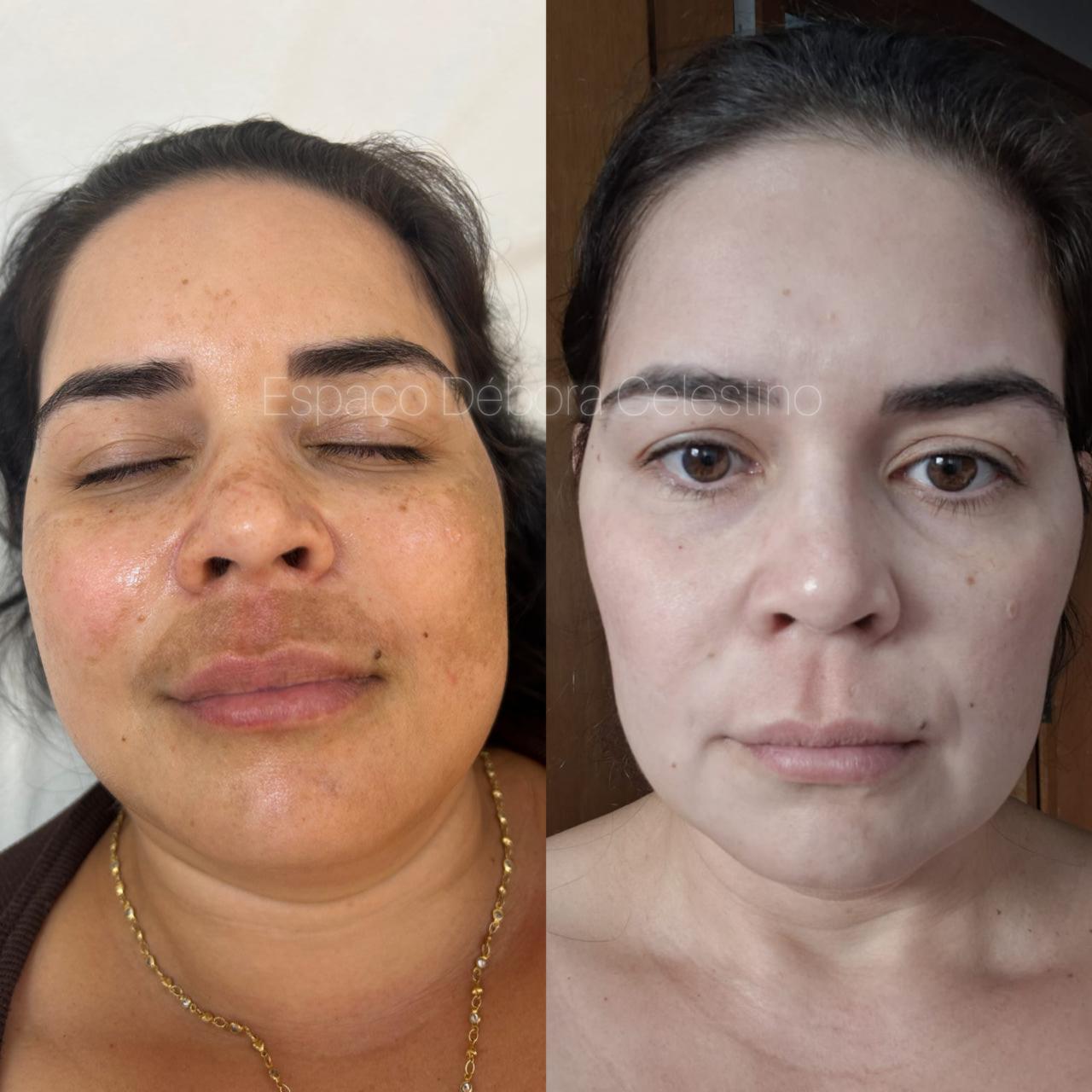 Resultado real 6 — Protocolo Renewal Clareamento Inteligente